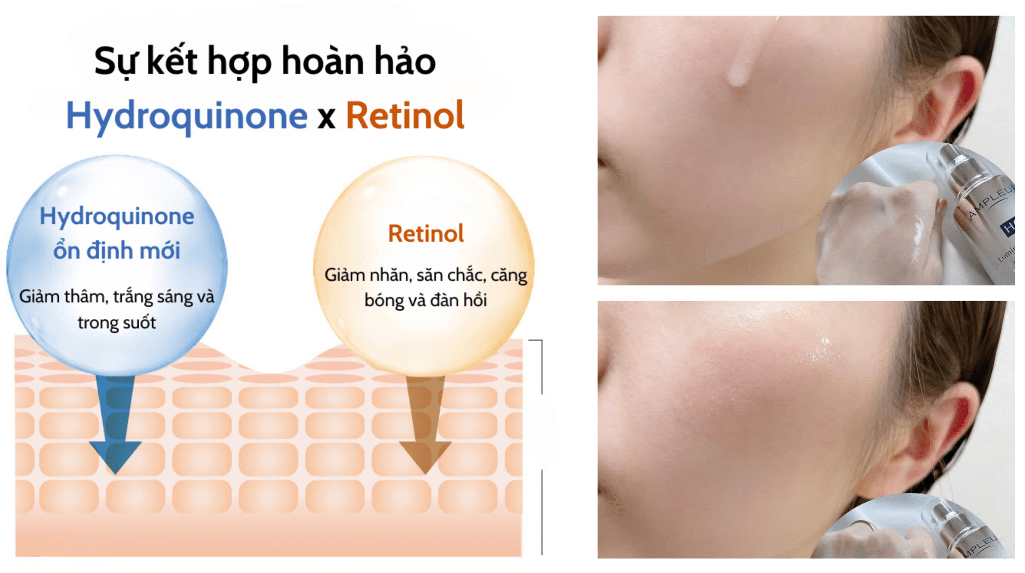 Kết hợp Hydroquinone và Retinol trong serum trắng sáng trị nám